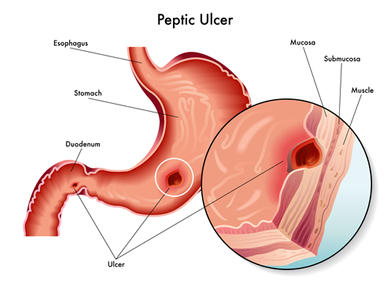 Peptic Ulcer Treatment & Diagnosis in London