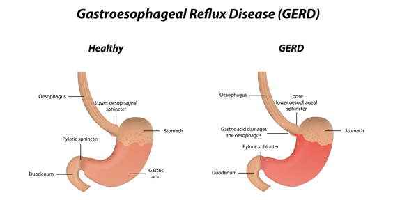 Gastro-Oesophageal Reflux Treatment in London